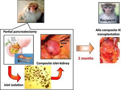 A Strategy to Simultaneously Cure Type 1 Diabetes and Diabetic Nephropathy by Transplant of Composite Islet-Kidney Grafts